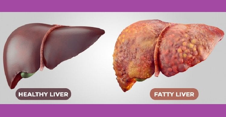 ফ্যাটি লিভারের সমস্যা কমানোর খাবার